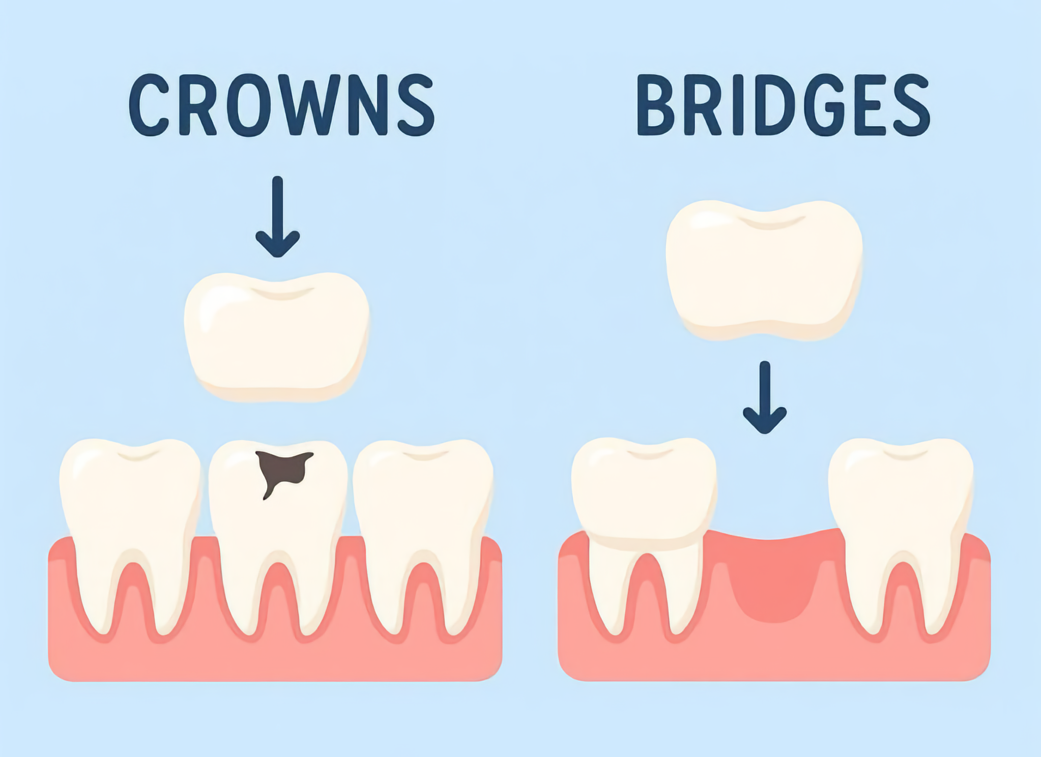 Dental Crowns and Bridges